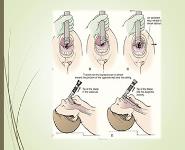 Endotracheal Intubation PowerPoint Presentation