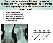 Odontogenic Infections-Pharyngitis Deep Neck Space Infections PowerPoint Presentation