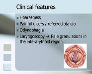 Chronic Laryngitis PowerPoint Presentation