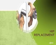 Hip Replacement PowerPoint Presentation
