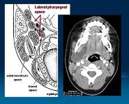 Odontogenic Infection Pathway PowerPoint Presentation