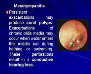 Chronic Otitis Media PowerPoint Presentation