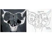 Nasal Polyposis PowerPoint Presentation