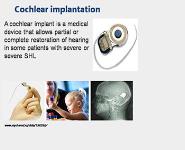 Non-Purulent Ear Diseases PowerPoint Presentation