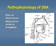 Surgical Management of Obstructive Sleep Apnea PowerPoint Presentation