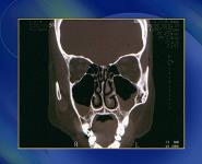 Medical Management of Rhinosinusitis in The Clinic PowerPoint Presentation