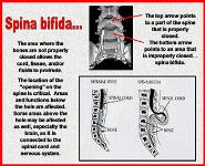 Birth Defects PowerPoint Presentation Notes