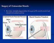 Strabismus Amblyopia and Leukocoria PowerPoint Presentation