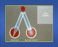 Amblyopia PowerPoint Presentation Notes