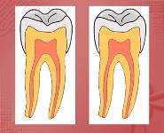 Dental Caries PowerPoint Presentation