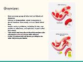 Sickle Cell Anemia