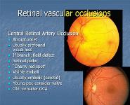 Acute Visual Loss PowerPoint Presentation
