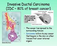 Breast Cancer PowerPoint Presentation