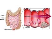 SCREENING OF COLORECTAL CANCER