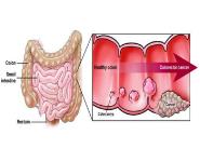 SCREENING OF COLORECTAL CANCER Medical Notes