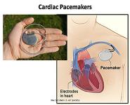 Cardiac Pacemaker PowerPoint Presentation