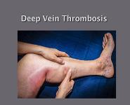 Deep Vein Thrombosis PowerPoint Presentation