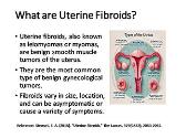 Comprehensive Guide to Uterine Fibroids: Symptoms, Diagnosis, and Treatment