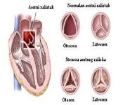 Ekg Patologija PowerPoint Presentation