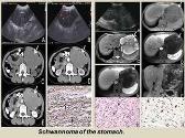 Radiological Imaging of Gastrointestinal tract Schwannoma