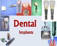 Dental Implants PowerPoint Presentation